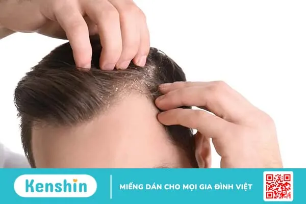 Các bệnh về da đầu ở nam giới: Nhận diện sớm, ngăn chặn nhanh!