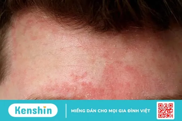 Các bệnh về da đầu ở nam giới: Nhận diện sớm, ngăn chặn nhanh!