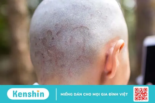 Các bệnh về da đầu ở nam giới: Nhận diện sớm, ngăn chặn nhanh!