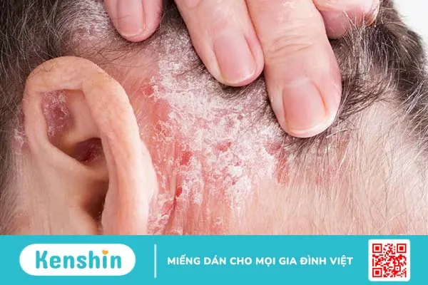 Các bệnh về da đầu ở nam giới: Nhận diện sớm, ngăn chặn nhanh!