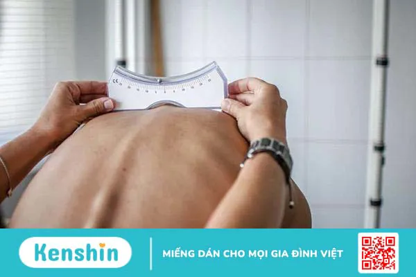 Các dạng cong vẹo cột sống thường gặp mà bạn nên biết Các dạng cong vẹo cột sống thường gặp mà bạn nên biết