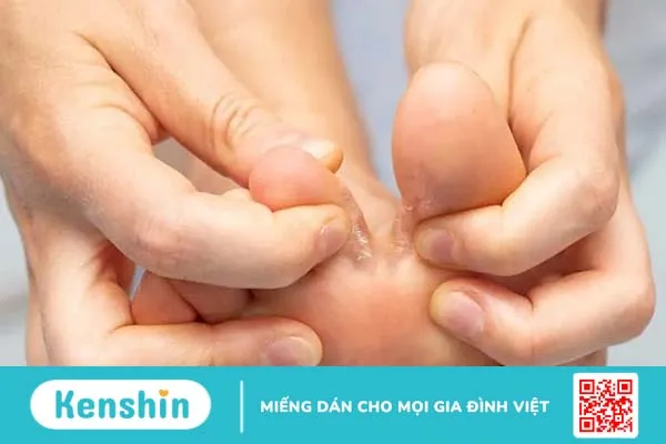 Các loại nấm da và cách ngăn ngừa bệnh hiệu quả