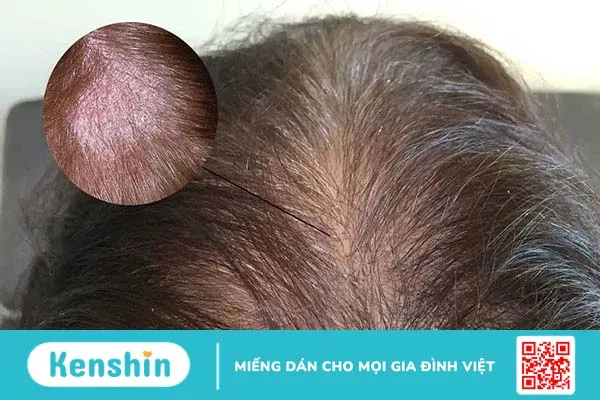 Các loại nấm da và cách ngăn ngừa bệnh hiệu quả