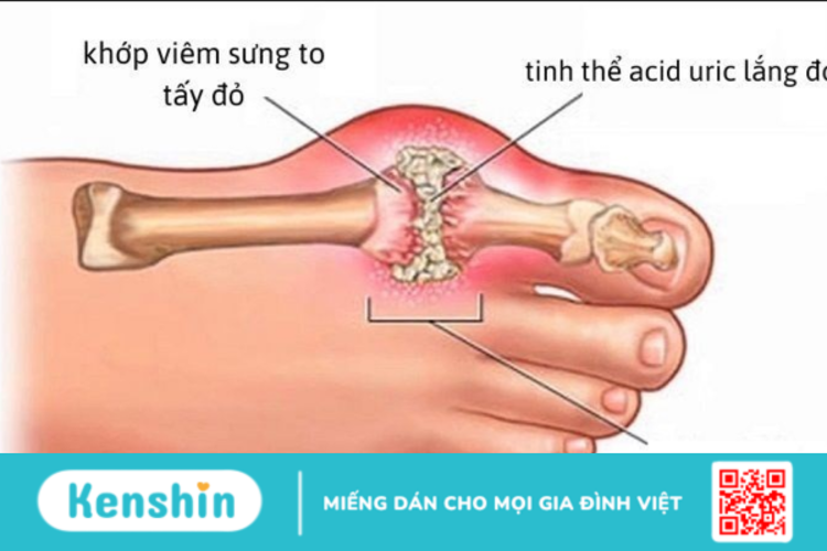 Các loại thuốc chữa bệnh gout thường dùng