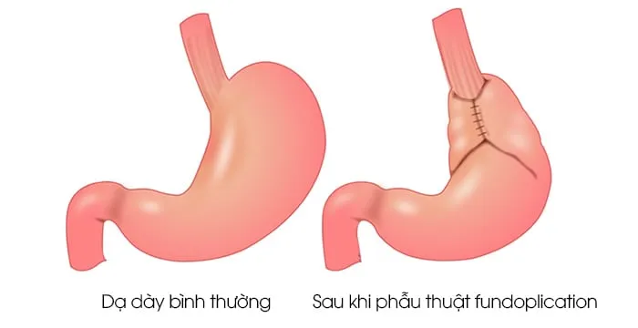 Các lựa chọn phẫu thuật điều trị trào ngược dạ dày thực quản