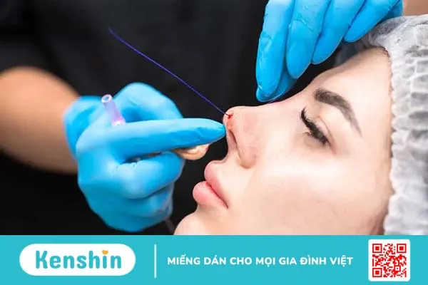 Các phương pháp nâng mũi phổ biến hiện nay