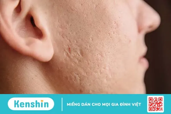 Các phương pháp trị sẹo lõm lâu năm, lấp đầy sẹo hiệu quả