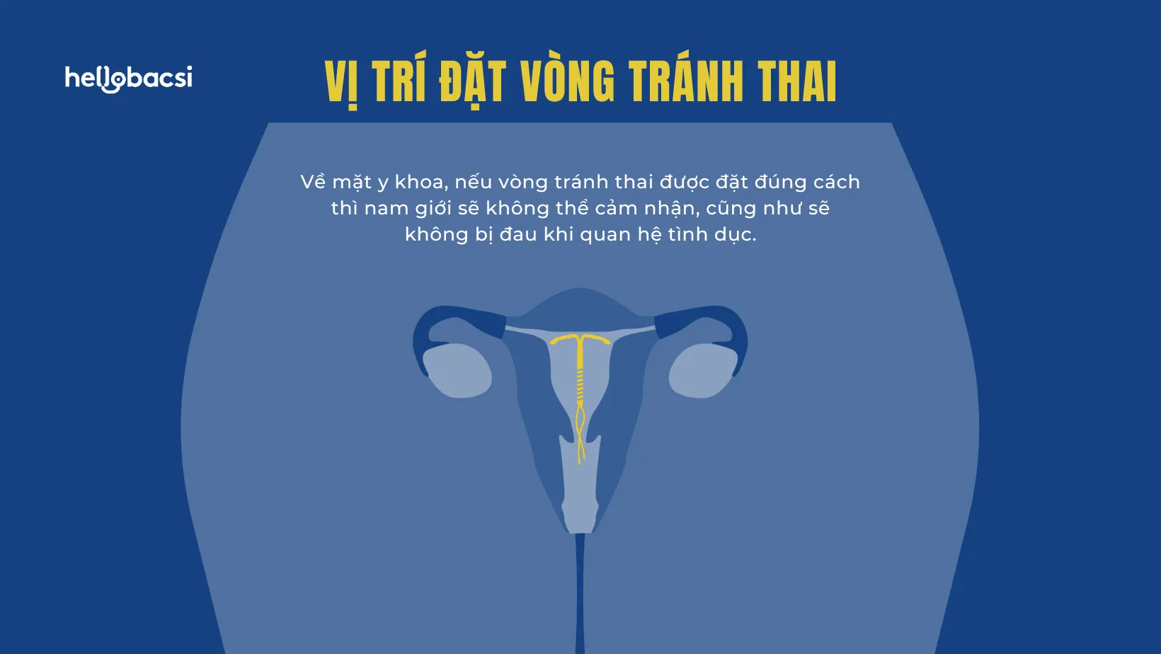 Các tư thế quan hệ sau khi đặt vòng tránh thai an toàn