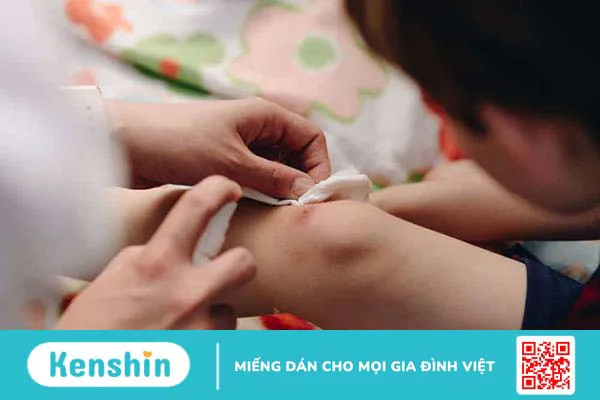 Cách làm tan vết bầm cho trẻ và lưu ý các trường hợp cần đi khám