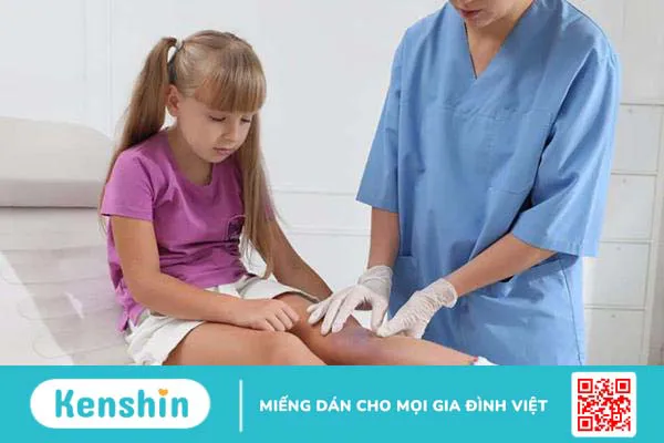 Cách làm tan vết bầm cho trẻ và lưu ý các trường hợp cần đi khám