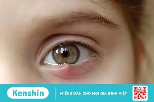 Cách trị lẹo mắt sau 1 đêm liệu có hiệu nghiệm?