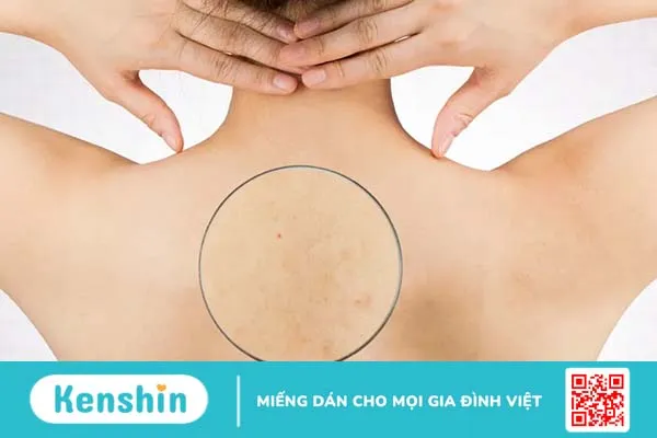 Cách trị mụn ở cổ và lưng: nhanh, không để lại sẹo thâm