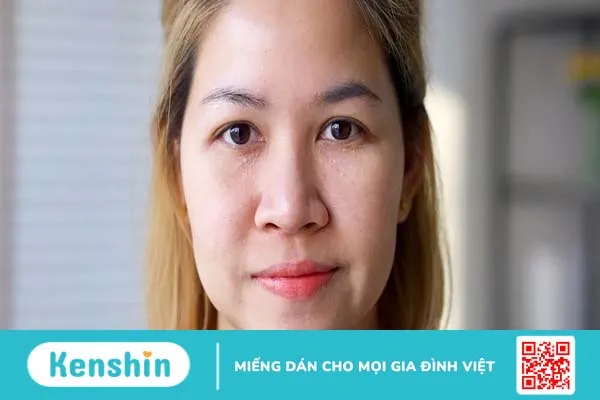 Cách trị mụn thịt trên mặt đơn giản, hiệu quả cao