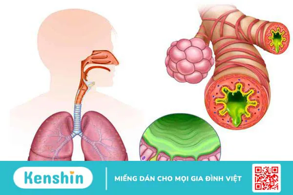 Cảm lạnh có nguy hiểm không? Những biến chứng nghiêm trọng