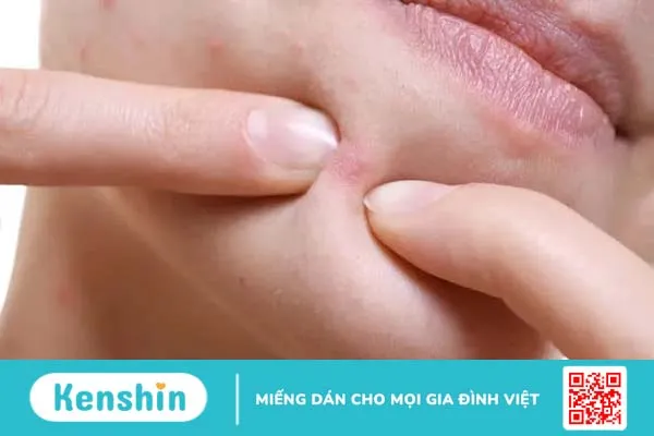 Cẩm nang hướng dẫn tự nặn mụn an toàn