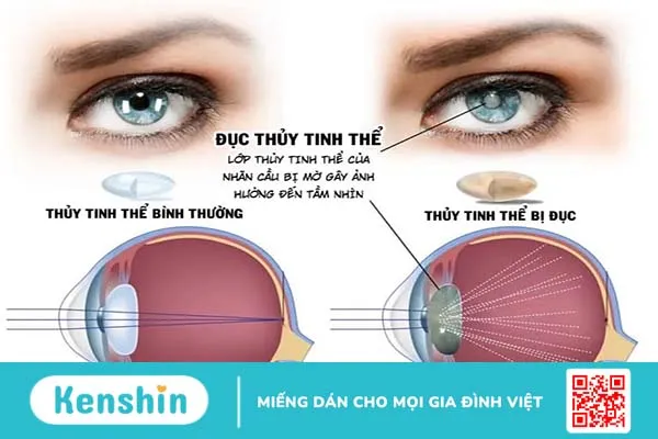 Cần làm gì để giúp hồi phục nhanh sau mổ đục thủy tinh thể?