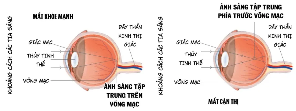 Cận thị