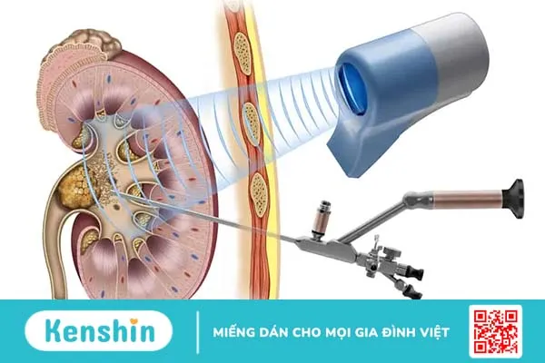 Cẩn trọng trước những biến chứng sau mổ sỏi niệu quản