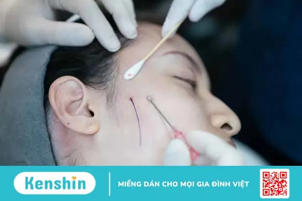 Căng chỉ collagen có an toàn không?