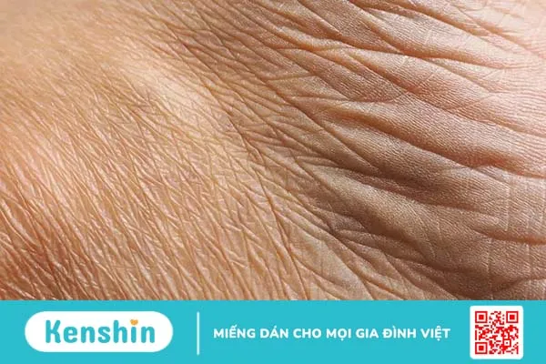 Căng chỉ collagen có an toàn không?