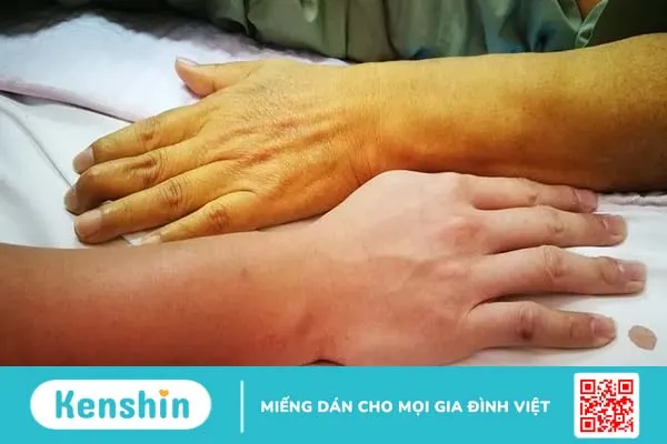 Cảnh giác với 11 dấu hiệu ung thư tụy giai đoạn đầu