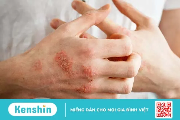 Cảnh giác với 11 dấu hiệu ung thư tụy giai đoạn đầu