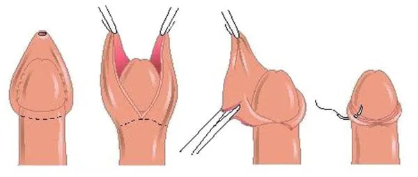 Cắt bao quy đầu ở đâu an toàn và cần chuẩn bị những gì?