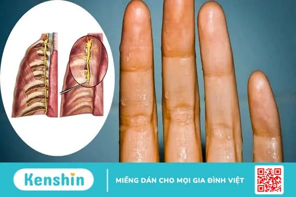 Cắt hạch giao cảm điều trị mồ hôi nhiều