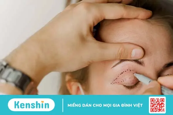 Cắt mí mắt