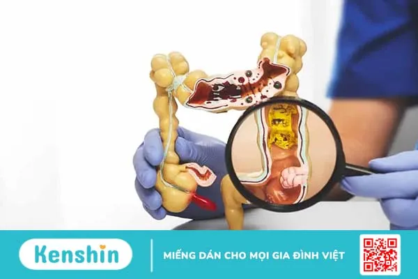 Cắt polyp đại tràng diễn ra như thế nào, có đau không?