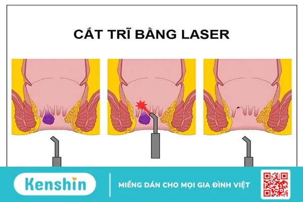 Cắt trĩ bằng laser là gì? Ưu, nhược điểm và quy trình cắt trĩ bằng laser