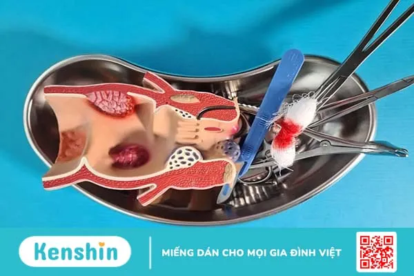 Cắt trĩ hết bao nhiêu tiền và cách để tiết kiệm chi phí cắt trĩ