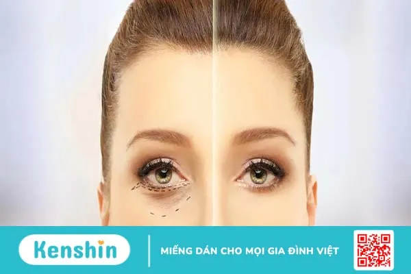 Cấy mỡ trẻ hóa vùng mắt là gì? Giữ được bao lâu?