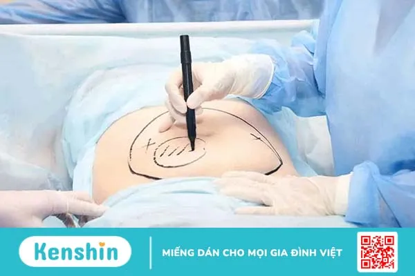 Cấy mỡ tự thân: Liệu có an toàn và hiệu quả dài lâu?