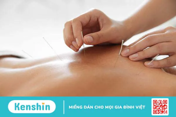 Châm cứu có tác dụng gì? Có nên châm cứu tại nhà?