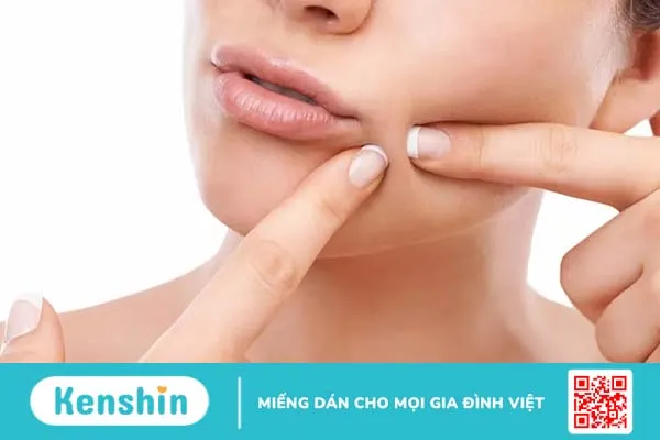 Chăm sóc da sau nặn mụn: 5 cách ngừa sẹo và thâm mụn