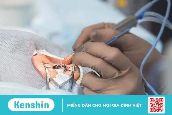 Chăm sóc mắt sau mổ đục thủy tinh thể cần lưu ý những gì?