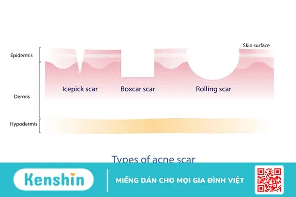 Chấm TCA là gì? Trị sẹo rỗ bằng TCA có đau không?