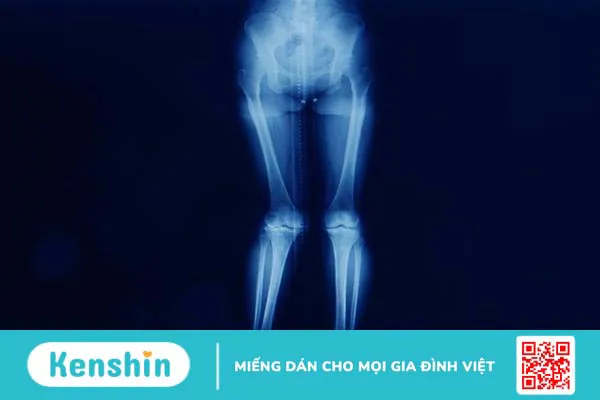 Chân chữ X ở trẻ nhỏ: Dấu hiệu nào giúp phát hiện sớm để cải thiện hiệu quả?