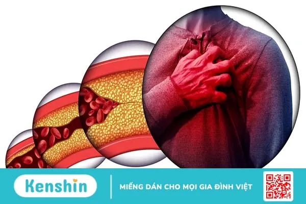 Chẩn đoán bệnh mạch vành bằng những xét nghiệm nào?