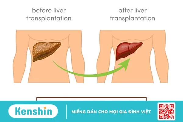 Chẩn đoán, điều trị và biến chứng của bệnh suy gan cấp