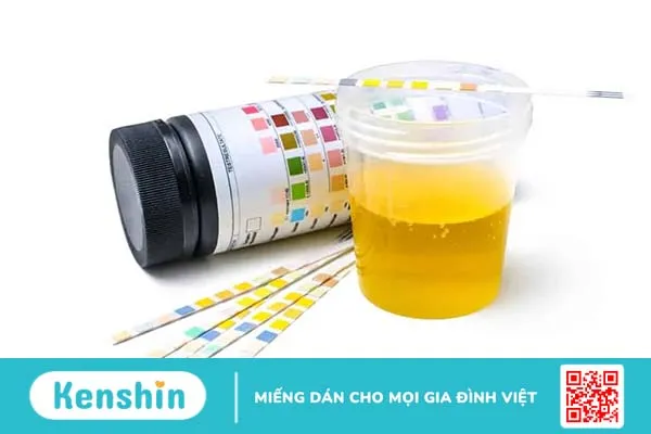 Chẩn đoán suy thận cấp bao gồm những xét nghiệm gì?