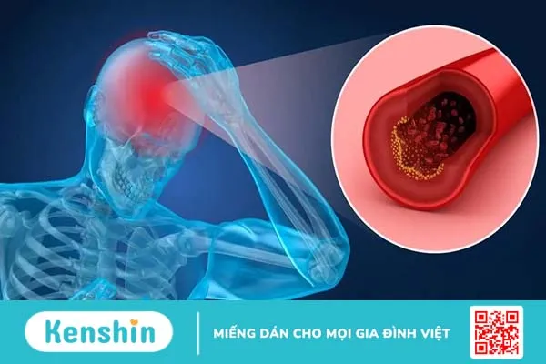 Chẩn đoán thiếu máu não: Cần thực hiện những xét nghiệm gì?