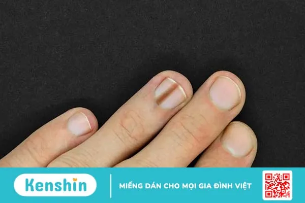 Chảy máu dưới móng khiến móng chân tay bị tím, bầm dập phải làm sao?