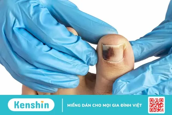 Chảy máu dưới móng khiến móng chân tay bị tím, bầm dập phải làm sao?