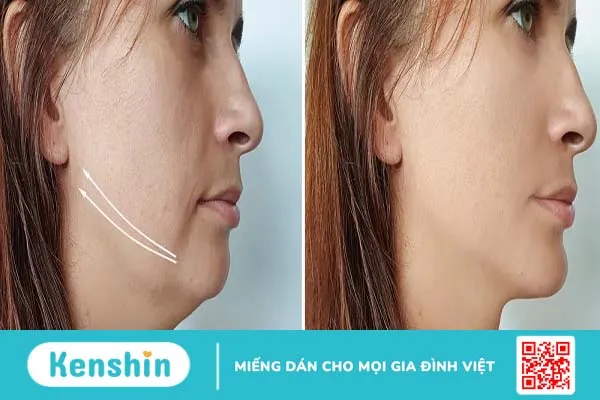 Chi tiết về phương pháp nâng cơ mặt bằng chỉ