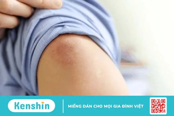 Chích ngừa ung thư cổ tử cung và những điều bạn cần biết