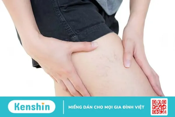 Chích xơ tĩnh mạch là gì? Quy trình và những lưu ý quan trọng cho bệnh nhân