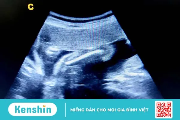 Chiều dài xương đùi thai nhi và yếu tố ảnh hưởng đến chỉ số này