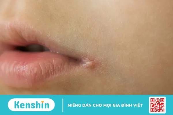 Chốc mép là gì? Nguyên nhân, triệu chứng và cách trị lở mép miệng